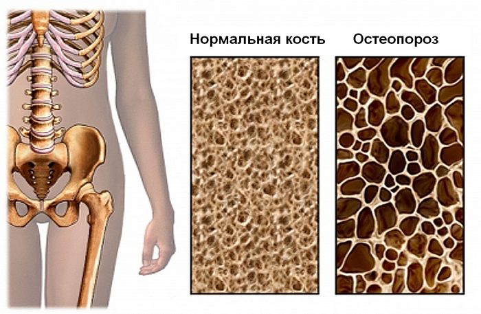 лечение остеопороза москва