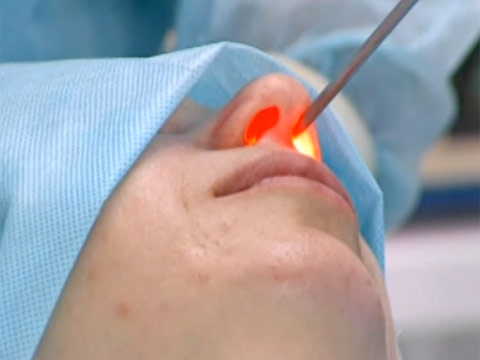 Операция удаления полипов в носу лазером