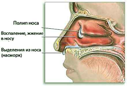 лечение полипов в носу в москве
